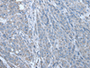 Immunohistochemistry of paraffin-embedded Human liver cancer tissue  using ZC3HAV1 Polyclonal Antibody at dilution of 1:70(×200)