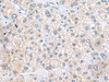 Immunohistochemistry of paraffin-embedded Human liver cancer tissue  using ZNF35 Polyclonal Antibody at dilution of 1:40(×200)