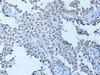 Immunohistochemistry of paraffin-embedded Human ovarian cancer tissue  using ZNF703 Polyclonal Antibody at dilution of 1:55(×200)