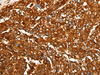 Immunohistochemistry of paraffin-embedded Human liver cancer tissue  using PEAR1 Polyclonal Antibody at dilution of 1:25(×200)