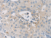 Immunohistochemistry of paraffin-embedded Human breast cancer tissue  using WFDC3 Polyclonal Antibody at dilution of 1:40(×200)