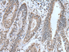 Immunohistochemistry of paraffin-embedded Human liver cancer tissue  using UBA52 Polyclonal Antibody at dilution of 1:55(×200)