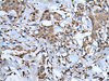 Immunohistochemistry of paraffin-embedded Human breast cancer tissue  using UBA52 Polyclonal Antibody at dilution of 1:55(×200)