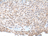 Immunohistochemistry of paraffin-embedded Human ovarian cancer tissue  using UBN1 Polyclonal Antibody at dilution of 1:130(×200)