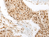 Immunohistochemistry of paraffin-embedded Human esophagus cancer tissue  using ATE1 Polyclonal Antibody at dilution of 1:60(×200)