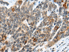 Immunohistochemistry of paraffin-embedded Human thyroid cancer tissue  using ATRX Polyclonal Antibody at dilution of 1:50(×200)