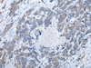 Immunohistochemistry of paraffin-embedded Human thyroid cancer tissue  using ATM Polyclonal Antibody at dilution of 1:65(×200)