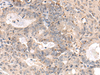 Immunohistochemistry of paraffin-embedded Human ovarian cancer tissue  using MEDAG Polyclonal Antibody at dilution of 1:75(×200)