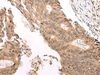 Immunohistochemistry of paraffin-embedded Human colorectal cancer tissue  using CHAMP1 Polyclonal Antibody at dilution of 1:40(×200)
