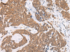 Immunohistochemistry of paraffin-embedded Human thyroid cancer tissue  using CHAMP1 Polyclonal Antibody at dilution of 1:40(×200)