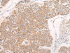 Immunohistochemistry of paraffin-embedded Human prost at e cancer tissue  using C14orf2 Polyclonal Antibody at dilution of 1:60(×200)