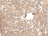 Immunohistochemistry of paraffin-embedded Human esophagus cancer tissue  using CACNG5 Polyclonal Antibody at dilution of 1:50(×200)