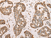 Immunohistochemistry of paraffin-embedded Human esophagus cancer tissue  using CAPN9 Polyclonal Antibody at dilution of 1:45(×200)