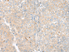 Immunohistochemistry of paraffin-embedded Human liver cancer tissue  using CAMK2A Polyclonal Antibody at dilution of 1:55(×200)