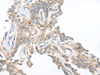 Immunohistochemistry of paraffin-embedded Human ovarian cancer tissue  using CAMK2A Polyclonal Antibody at dilution of 1:55(×200)