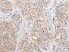 Immunohistochemistry of paraffin-embedded Human prost at e cancer tissue  using CPD Polyclonal Antibody at dilution of 1:70(×200)