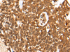 Immunohistochemistry of paraffin-embedded Human thyroid cancer tissue  using CASP8 Polyclonal Antibody at dilution of 1:35(×200)