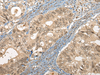 Immunohistochemistry of paraffin-embedded Human colorectal cancer tissue  using CC2D1A Polyclonal Antibody at dilution of 1:35(×200)