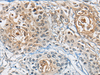 Immunohistochemistry of paraffin-embedded Human prost at e cancer tissue  using CD8A Polyclonal Antibody at dilution of 1:100(×200)