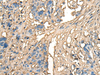 Immunohistochemistry of paraffin-embedded Human lung cancer tissue  using CELA1 Polyclonal Antibody at dilution of 1:70(×200)