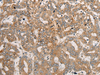 Immunohistochemistry of paraffin-embedded Human liver cancer tissue  using CEND1 Polyclonal Antibody at dilution of 1:50(×200)