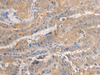 Immunohistochemistry of paraffin-embedded Human thyroid cancer tissue  using AGAP3 Polyclonal Antibody at dilution of 1:25(×200)