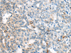 Immunohistochemistry of paraffin-embedded Human liver cancer tissue  using CES2 Polyclonal Antibody at dilution of 1:55(×200)