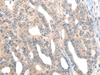 Immunohistochemistry of paraffin-embedded Human liver cancer tissue  using CORO2B Polyclonal Antibody at dilution of 1:50(×200)