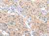 Immunohistochemistry of paraffin-embedded Human esophagus cancer tissue  using MIIP Polyclonal Antibody at dilution of 1:45(×200)