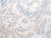 Immunohistochemistry of paraffin-embedded Human gastric cancer tissue  using PNPO Polyclonal Antibody at dilution of 1:30(×200)