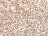 Immunohistochemistry of paraffin-embedded Human lung cancer tissue  using CPS1 Polyclonal Antibody at dilution of 1:35(×200)
