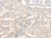 Immunohistochemistry of paraffin-embedded Human liver cancer tissue  using CYB5R3 Polyclonal Antibody at dilution of 1:50(×200)
