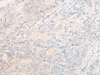 Immunohistochemistry of paraffin-embedded Human gastric cancer tissue  using CYB5R3 Polyclonal Antibody at dilution of 1:50(×200)