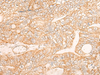 Immunohistochemistry of paraffin-embedded Human gastric cancer tissue  using KRT9 Polyclonal Antibody at dilution of 1:30(×200)