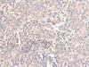 Immunohistochemistry of paraffin-embedded Human cervical cancer tissue  using EMX1 Polyclonal Antibody at dilution of 1:25(×200)