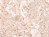 Immunohistochemistry of paraffin-embedded Human esophagus cancer tissue  using IL7 Polyclonal Antibody at dilution of 1:30(×200)