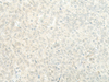 Immunohistochemistry of paraffin-embedded Human ovarian cancer tissue  using ESRP2 Polyclonal Antibody at dilution of 1:95(×200)