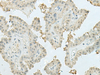 Immunohistochemistry of paraffin-embedded Human thyroid cancer tissue  using MECOM Polyclonal Antibody at dilution of 1:60(×200)