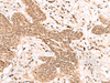 Immunohistochemistry of paraffin-embedded Human esophagus cancer tissue  using FAM111B Polyclonal Antibody at dilution of 1:50(×200)