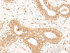 Immunohistochemistry of paraffin-embedded Human breast cancer tissue  using FBXL4 Polyclonal Antibody at dilution of 1:25(×200)