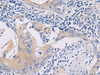 Immunohistochemistry of paraffin-embedded Human esophagus cancer tissue  using GALR3 Polyclonal Antibody at dilution of 1:50(×200)