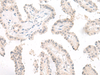 Immunohistochemistry of paraffin-embedded Human thyroid cancer tissue  using GHDC Polyclonal Antibody at dilution of 1:90(×200)