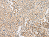 Immunohistochemistry of paraffin-embedded Human cervical cancer tissue  using GPR119 Polyclonal Antibody at dilution of 1:45(×200)