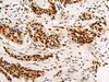 Immunohistochemistry of paraffin-embedded Human esophagus cancer tissue  using HNRNPA3 Polyclonal Antibody at dilution of 1:45(×200)