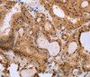 Immunohistochemistry of paraffin-embedded Human thyroid cancer using EPDR1 Polyclonal Antibody at dilution of 1:40