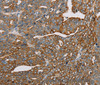 Immunohistochemistry of paraffin-embedded Human cervical cancer using MTFP1 Polyclonal Antibody at dilution of 1:30