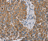 Immunohistochemistry of paraffin-embedded Human lung cancer using MTFP1 Polyclonal Antibody at dilution of 1:30