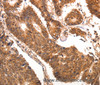 Immunohistochemistry of paraffin-embedded Human colon cancer using CCL17 Polyclonal Antibody at dilution of 1:70