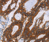 Immunohistochemistry of paraffin-embedded Human colon cancer using GPA33 Polyclonal Antibody at dilution of 1:30