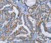 Immunohistochemistry of paraffin-embedded Human thyroid cancer using GPA33 Polyclonal Antibody at dilution of 1:30